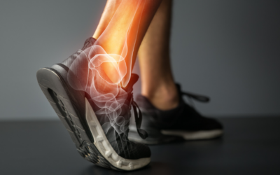 How to manage an ankle sprain