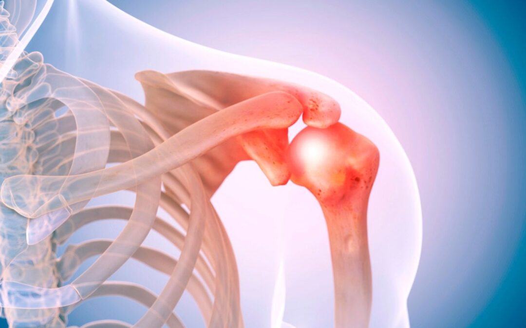 Shoulder Pain and how Physiotherapy can help