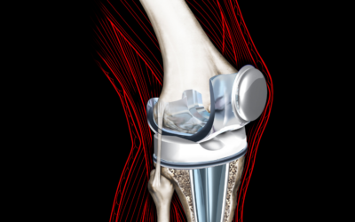 What is a Total Knee Replacement