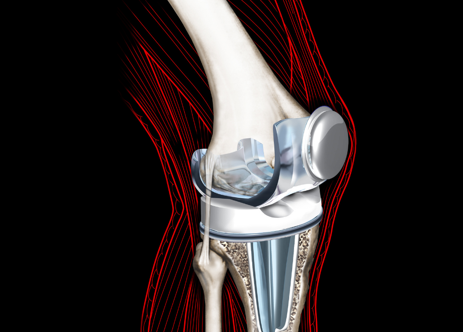 What is a Total Knee Replacement