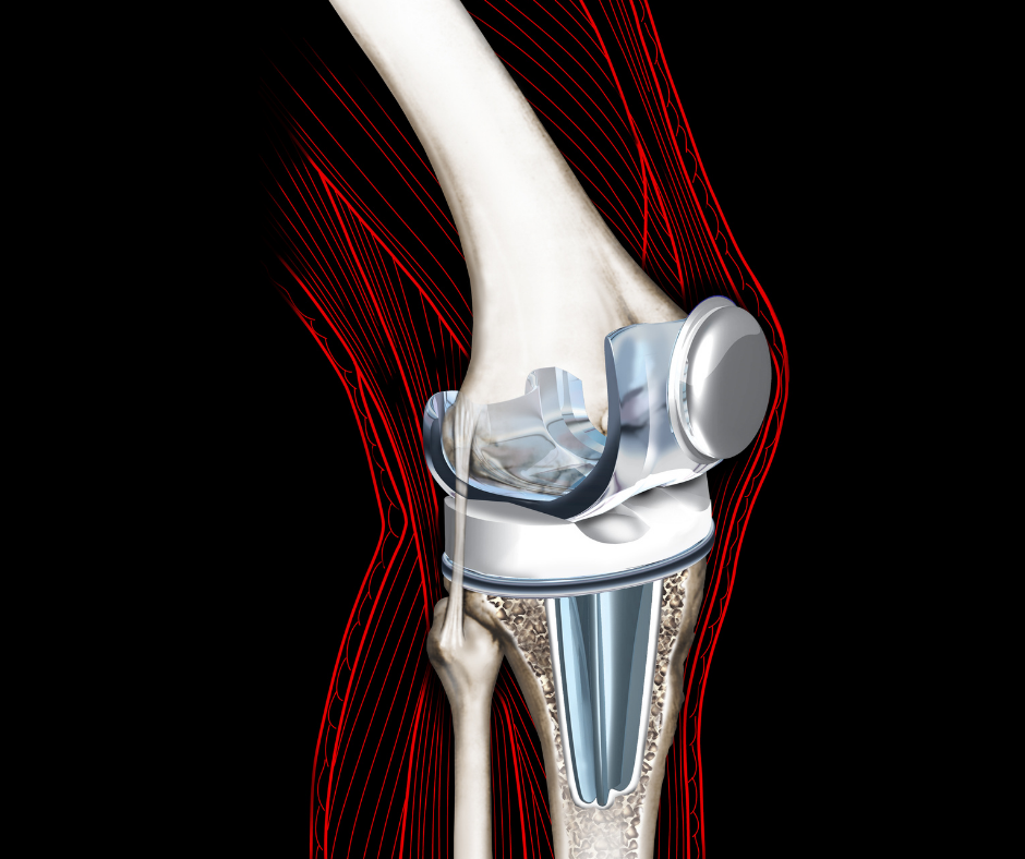 Total Knee Replacement