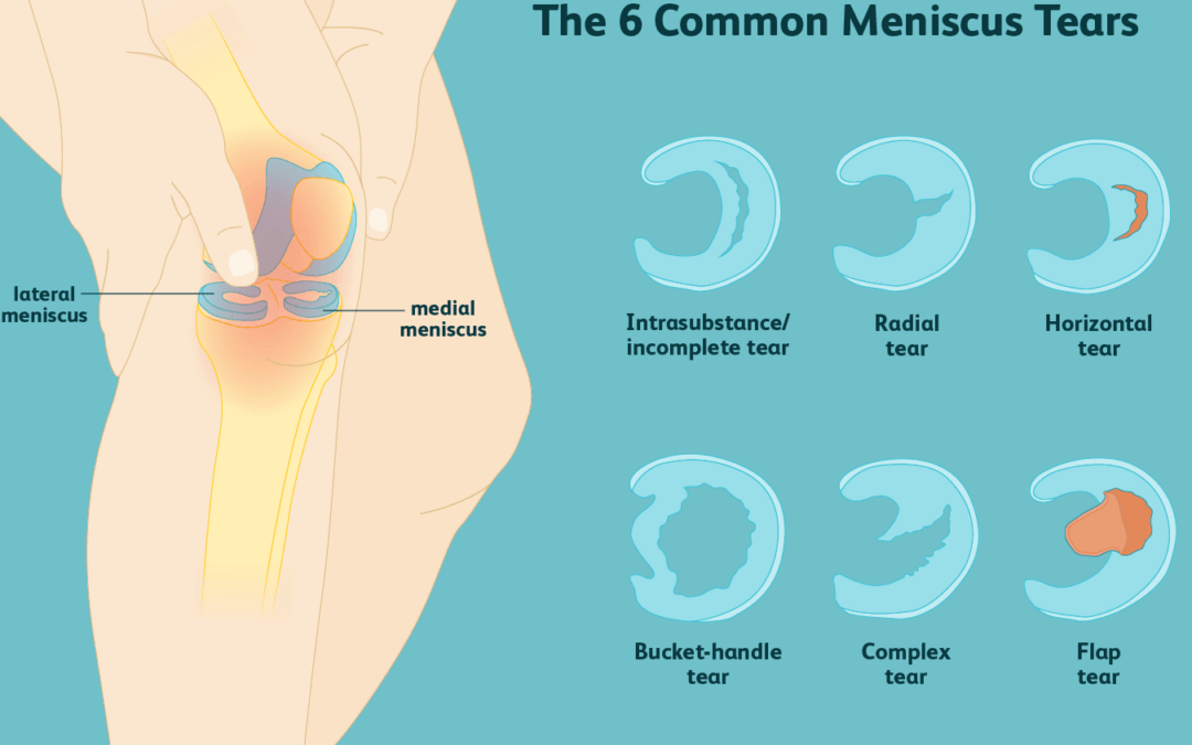 Is your meniscus causing your knee pain?