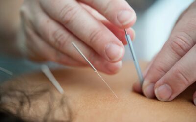 Treatment of the Week – Acupuncture